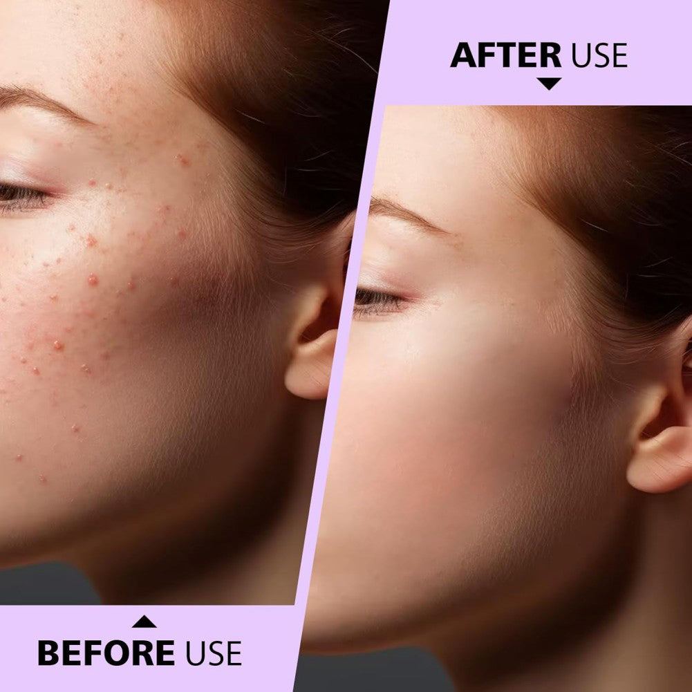 Before and after comparison of a person's face with acne treatment showing clearer skin.